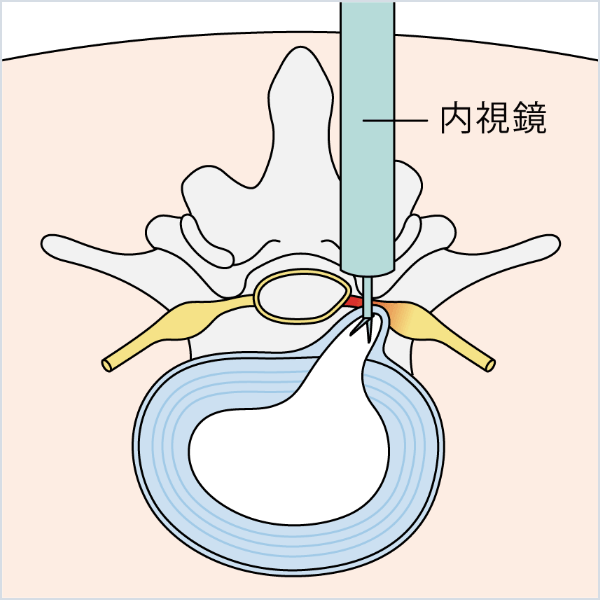 内視鏡下椎間板摘出術（MED）