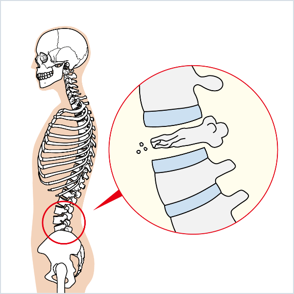 脊椎圧迫骨折（骨粗鬆症性椎体骨折）