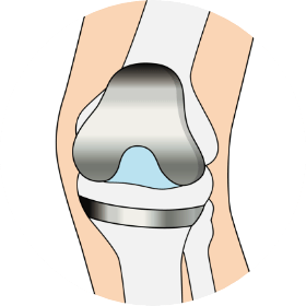 人工膝関節全置換術（TKA）