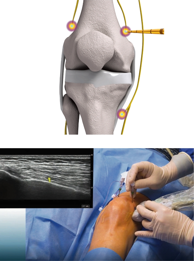 ターゲットとする神経