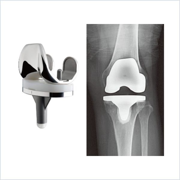 大腿骨後顆プレカット法による最適な軟部組織バランス獲得