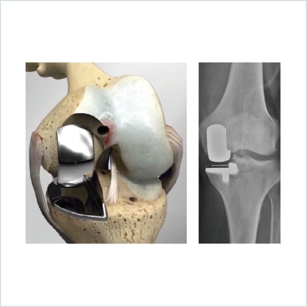 UKA (Unicompartmental Knee Arthroplasty)