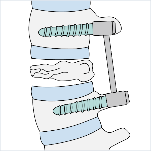 経皮的椎弓根スクリュー（PPS）を用いた低侵襲脊椎安定術（MISt）